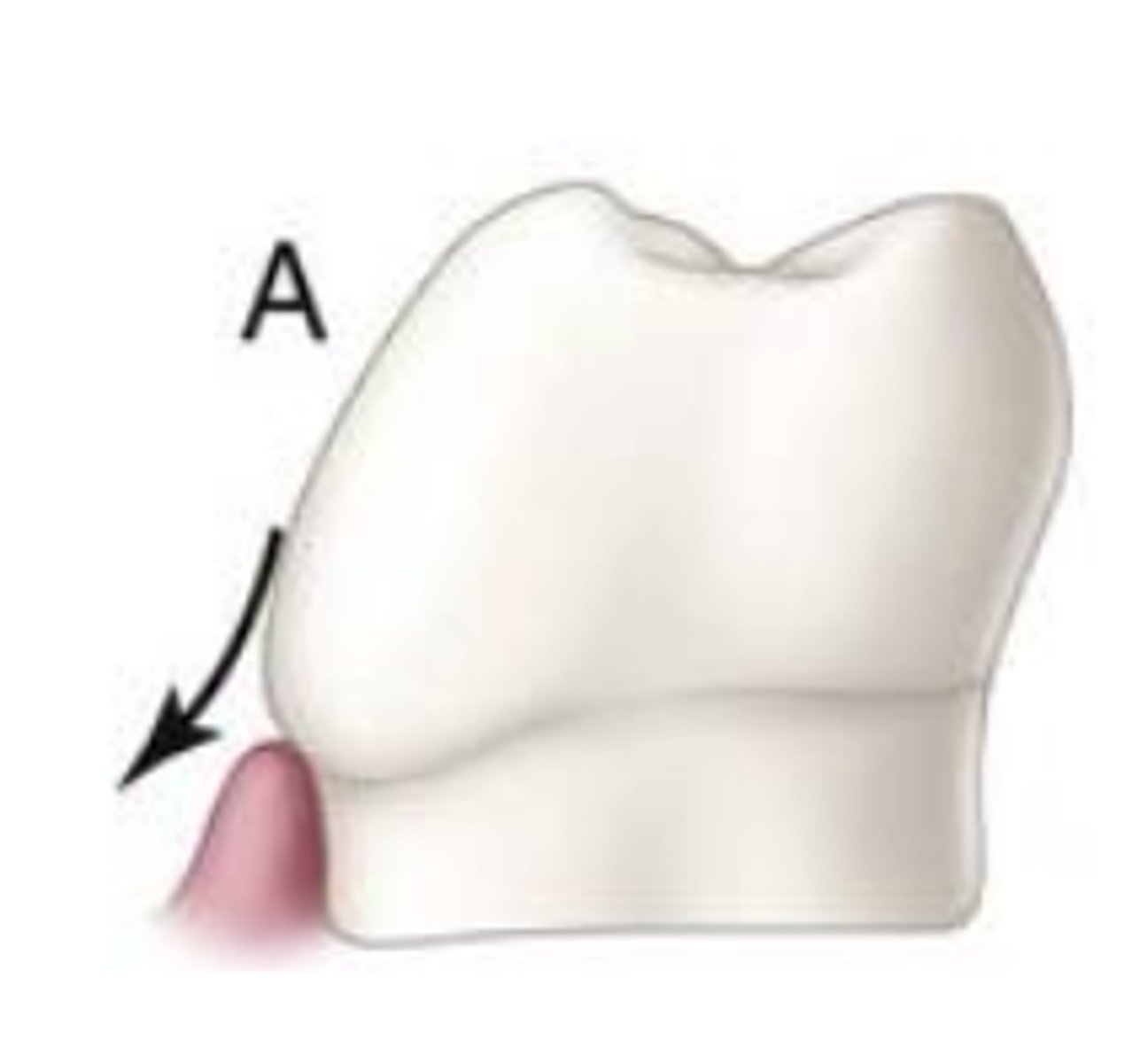 <p>Over-contoured tooth deflects food</p><p>from gingiva and results in...</p>