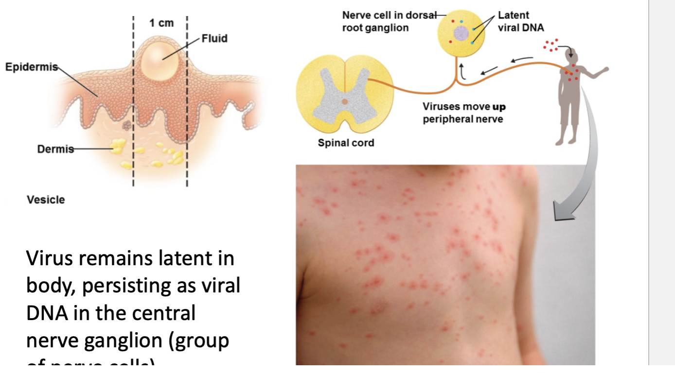 <p><span style="color: blue">Varicella </span>- Chickenpox</p><p>cause: Itchiness</p><ul><li><p>Herpesvirus Varicella-Zoter</p></li><li><p>DNA virus</p></li><li><p><strong>Transmitted via respiratory route</strong></p></li><li><p><strong>Caused Pus-filled Vesicles</strong></p></li><li><p><strong>Vesicles on skin (itchy)</strong></p><p>Symptoms</p></li><li><p>Latent in neurons of CNS</p></li><li><p><mark data-color="yellow" style="background-color: yellow; color: inherit">Reactivation leads to shingles</mark></p></li></ul><p></p><ul><li><p>Varicella causes disease by:</p><ol><li><p>Infecting respiratory mucosa.</p></li><li><p>Disseminating through blood to skin and internal organs.</p></li><li><p>Causing a systemic immune response and characteristic rash.</p></li></ol></li></ul><p></p>