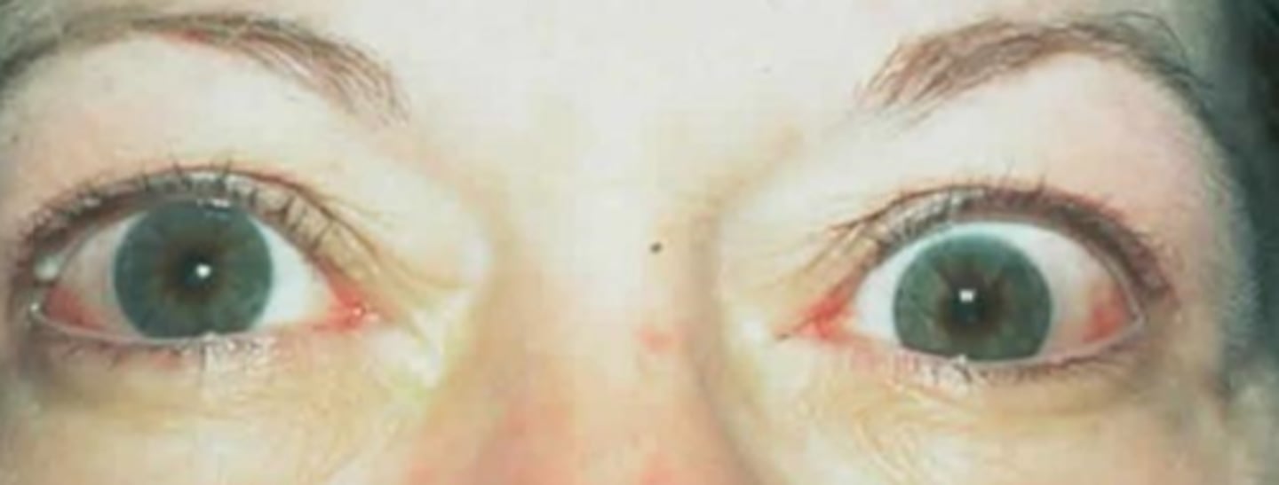 <p>paralytic strabismus = issues with CN 3, 4, 6</p><p>VF defects</p><p>polyoplia aka monocular diplopia from polycoria, bifocal CL, uncorrected astig</p><p>nystagmus</p>