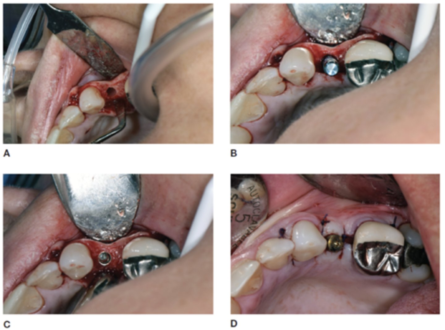 <p>dental implant surgery</p>
