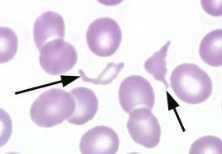 <p>-intravascular hemolysis</p><p>-endothelial damage and/or fibrin deposition</p><p>-secondary hemolysis</p><p>-+/- schistocytes</p>