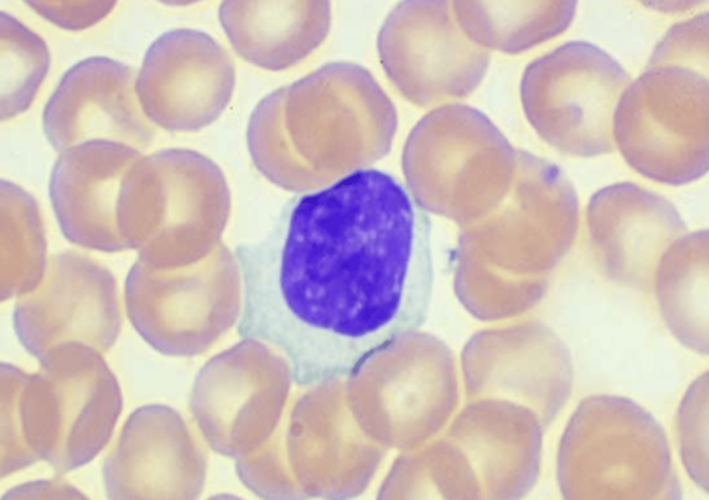 <p>&gt; shape: ~15 microns</p><p>&gt; nucleus: larger and more irregular ; chromatin is clumpy</p><p>&gt; cytoplasm: much more abundant ; blue rim, colorless near nucleus ; may have "scalloped" edges where it is indented by RBCs</p><p>&gt; rarest in PBS</p><p>&gt; if it contains adequate granulation, may be part of the "Killer Cells" subpopulation of thymus dependent cells</p>