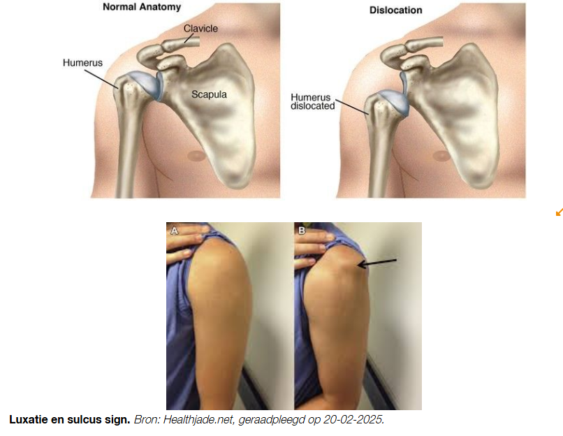 <p>er is dan sprake van multidirectionele instabiliteit</p>