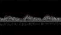 <p>what does this waveform indicate w <strong>stenosis</strong>?</p>