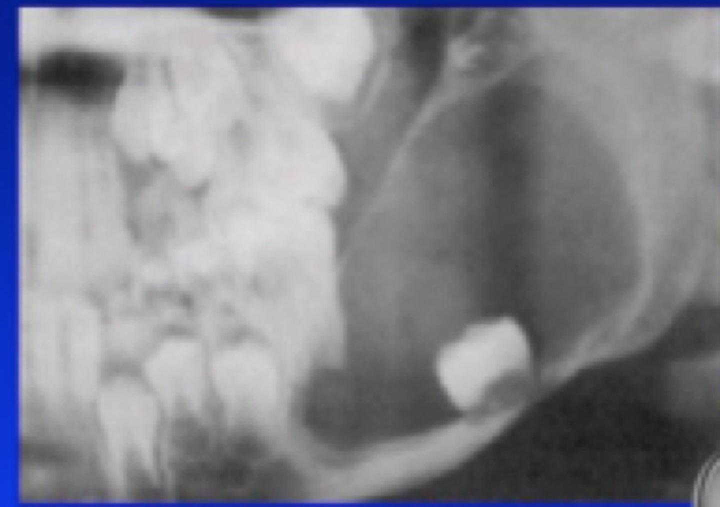 <p>1) mandible = 80%</p><p>2) posterior regions</p>