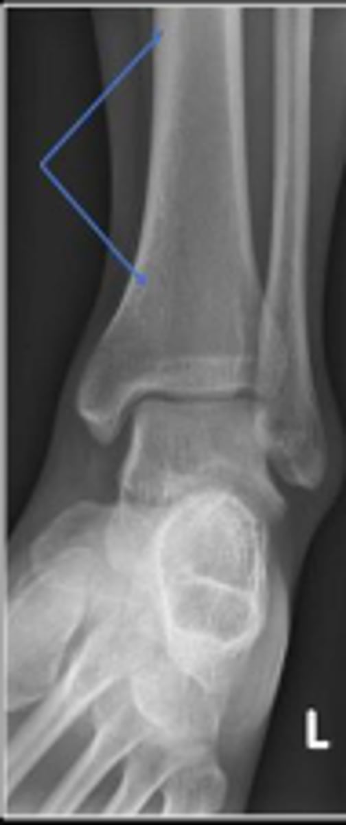 <p>What bone are the arrows pointing to?</p>