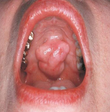 <p>segment or lobe part of whole lesion, sometimes appear fused </p>