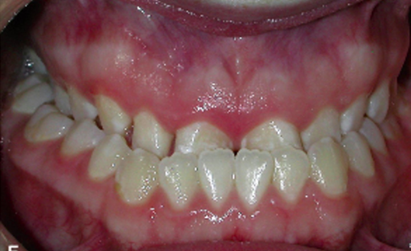 <p>ID the occlusion classification:</p>