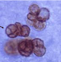 <ul><li><p><span><span>Skin scraping 10% KOH prep</span></span></p></li><li><p><span><span>Brown pigmented, planate-dividing rounded sclerotic bodies (aka copper pennis or muriform cells)</span></span></p></li><li><p><span><span>tissue biopsy</span></span></p></li></ul><p></p>