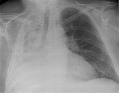 <p>Atelectasis </p>