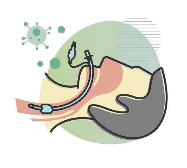 <ol><li><p>Foreign body, altered respiratory clearance mechanisms </p></li><li><p>Increased colonization → Candida pneumonia not likely </p></li></ol><p><strong><em>IF YOU FIND CANDIDA AT MULTIPLE SITES, IT IS MORE LIKELY </em></strong></p><p>Add antifungal early on in ICU settings</p>