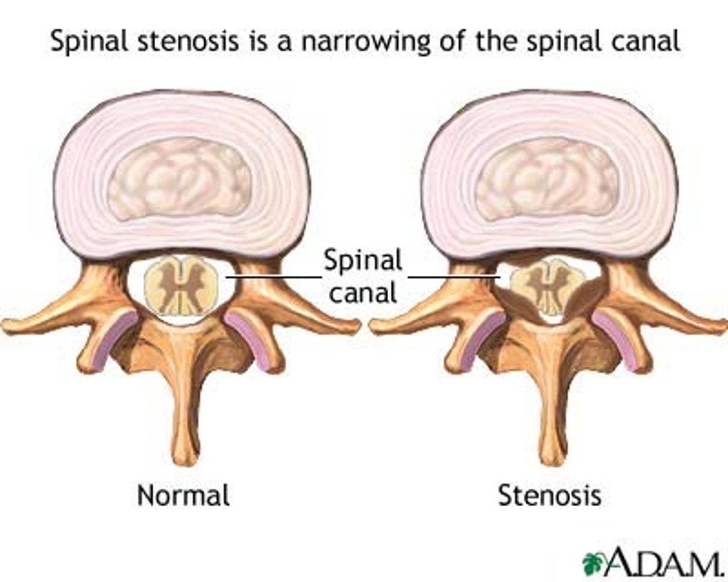 <p>⢠Narrowing of spinal canal</p><p>⢠Osteo or rheumatoid arthritis, spinal tumors, Paget's disease, traumatic damage to vertebral column, scoliosis</p><p>⢠Pain starts in lower back and radiates to buttock and leg & worsens with walking/sitting</p><p>⢠Decreased pain when pt bends is sign of stenosis</p>