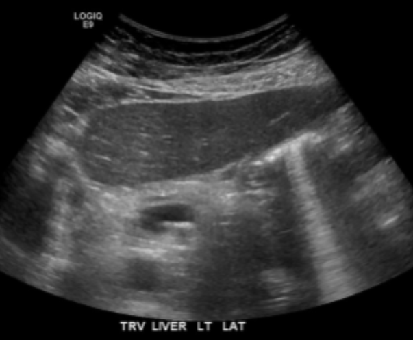 <ul><li><p><span style="background-color: transparent;">Type of reverberation artifact</span></p></li><li><p><span style="background-color: transparent;">Associated with gas – commonly seen in bowel</span></p></li><li><p><span style="background-color: transparent;">Appears as high amplitude streaks (bright white)</span></p></li><li><p><span style="background-color: transparent;">Can be helpful to identify gas in conditions such as:</span></p><ul><li><p><span style="background-color: transparent;">Pneumobilia – air in the bile ducts</span></p></li><li><p><span style="background-color: transparent;">Pneumo = lung, air</span></p></li></ul></li></ul><ul><li><p><span style="background-color: transparent;">Emphysematous cholecystitis – gas in the gallbladder wall</span></p></li><li><p><span style="background-color: transparent;">Abscesses containing air</span></p><ul><li><p><span style="background-color: transparent;">An abscess is a collection of pus that forms in a localized area of the body</span></p></li></ul></li></ul><p></p>