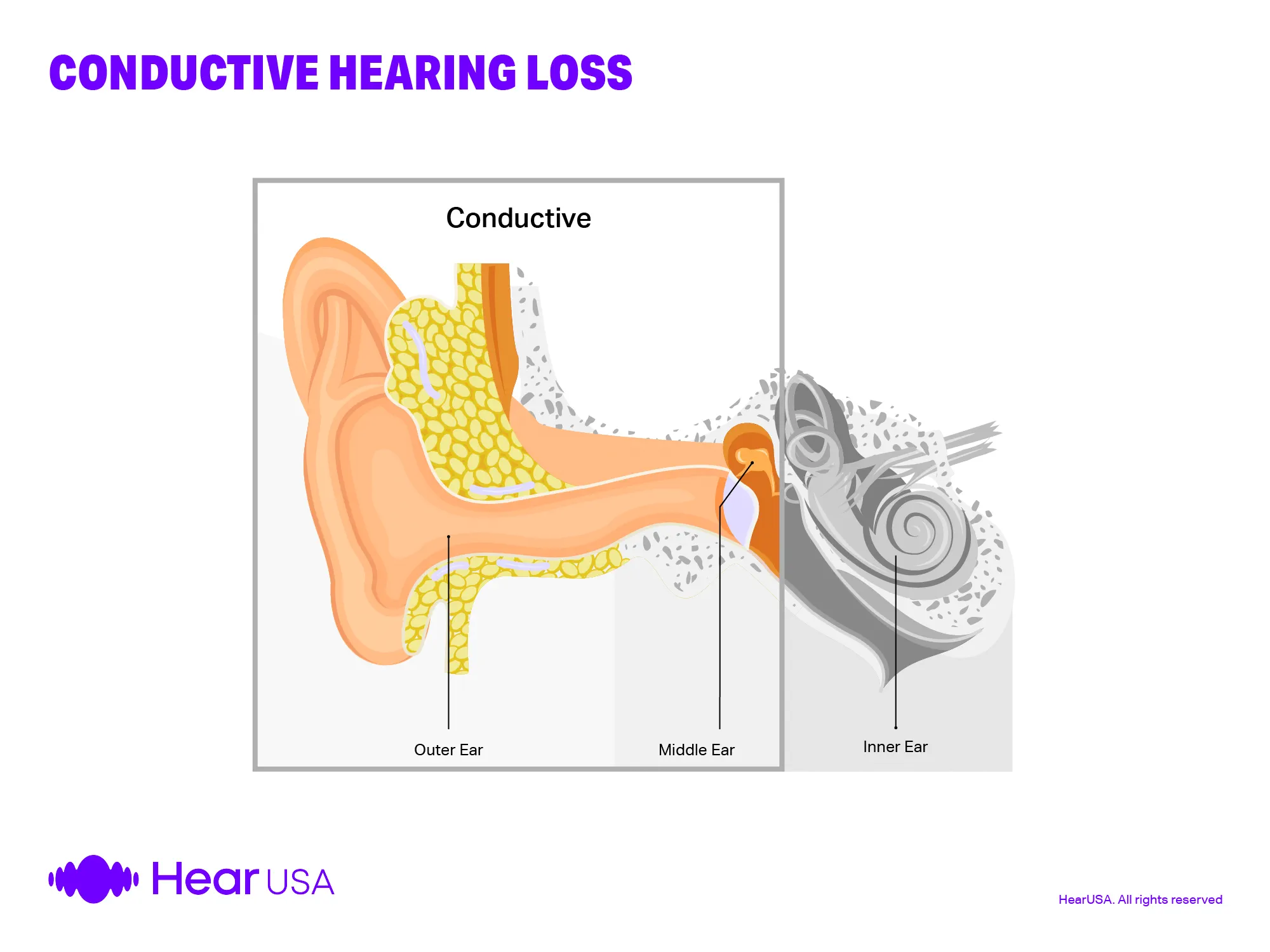 <p>Conduction deafness</p>