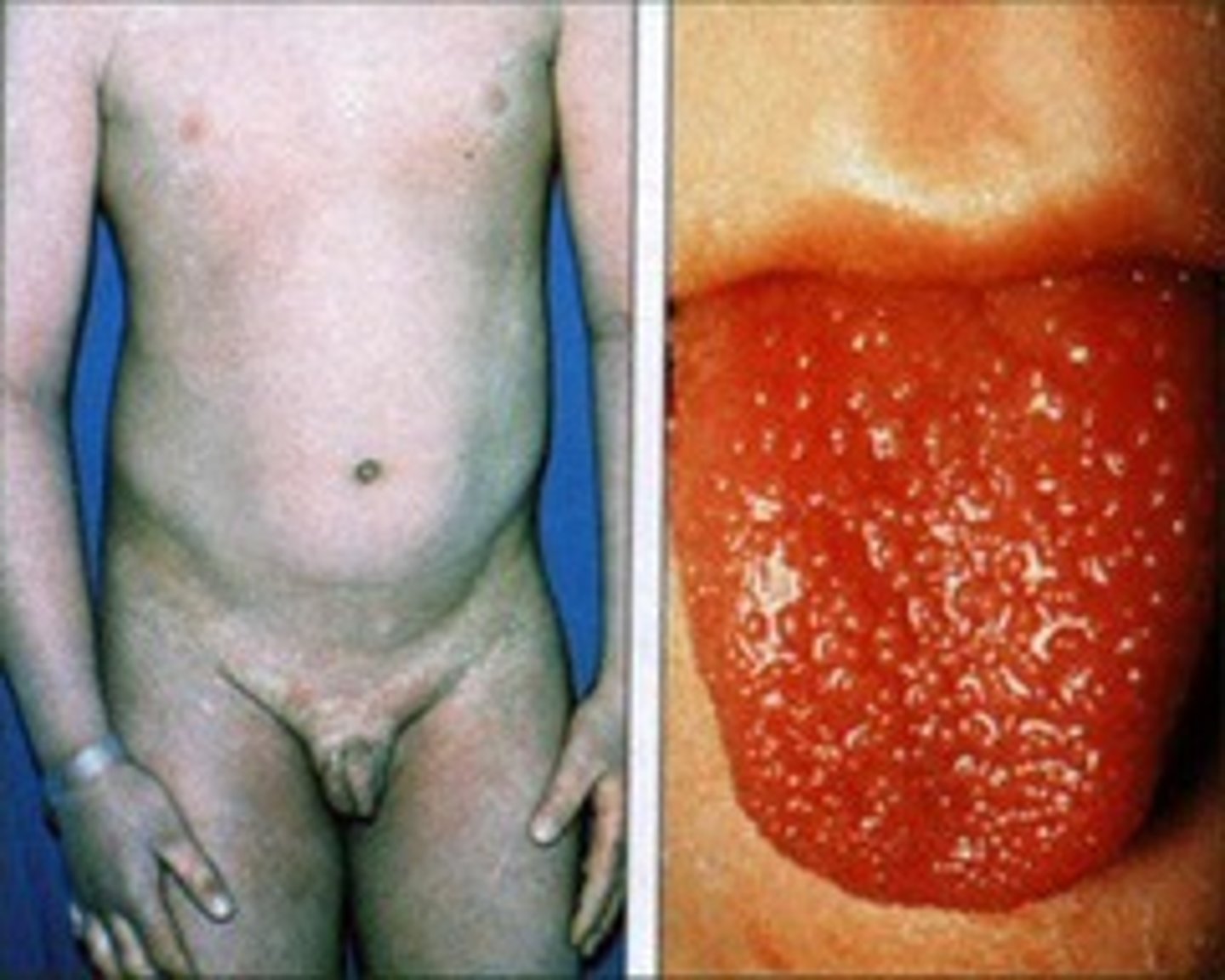 <p>-disseminated rash<br>-strawberry tongue<br>-caused by strep pyogene</p>