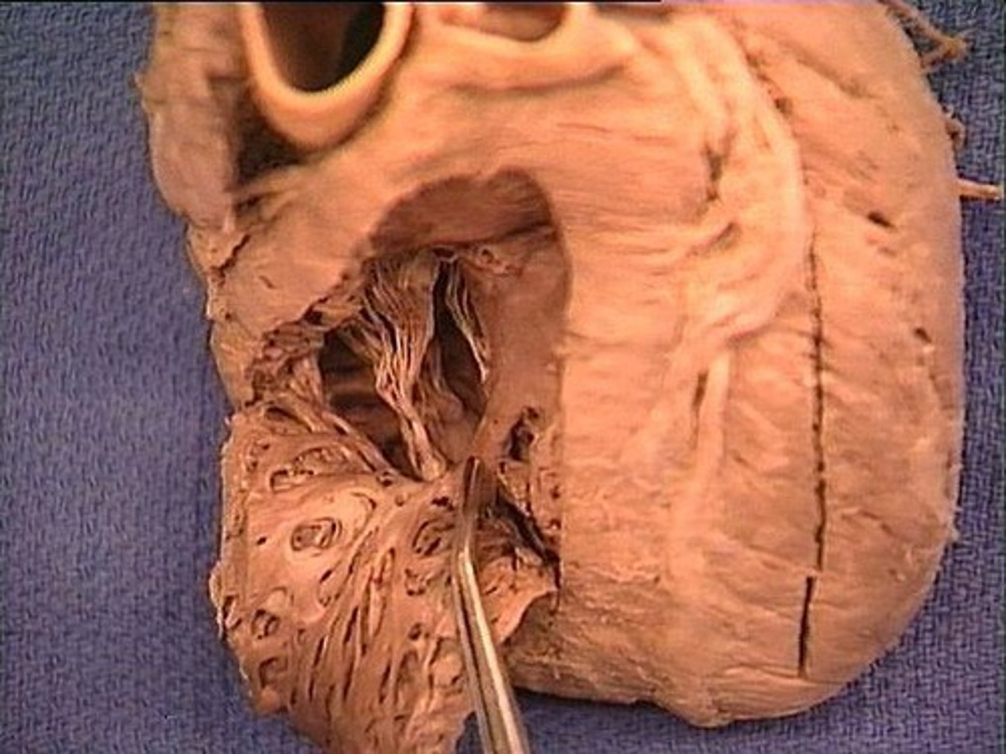 <p>ONLY in R ventricle</p>