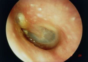 <p>Chronic suppurative otitis media</p><p>A long standing middle ear infection characterized by persistent hole in ear drum and discharge for at least 6 weeks.</p>