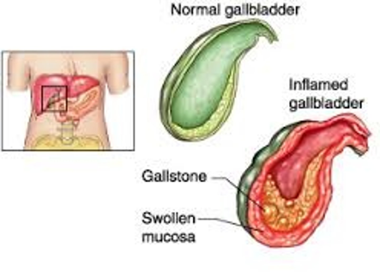 <p>inflammation of the gallbladder (can be acute or chronic)</p>