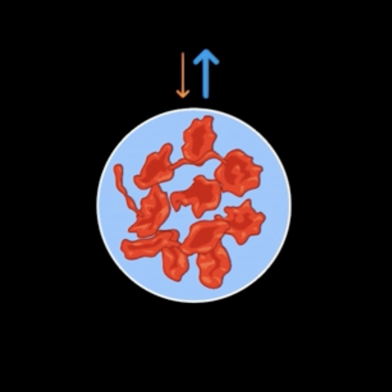 <p>hypernatremia</p>