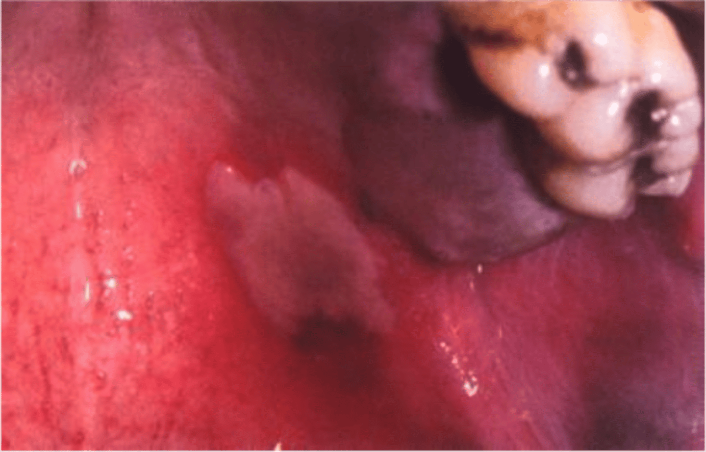 <p>PAINFUL</p><p>• cracked or cratered surface </p>