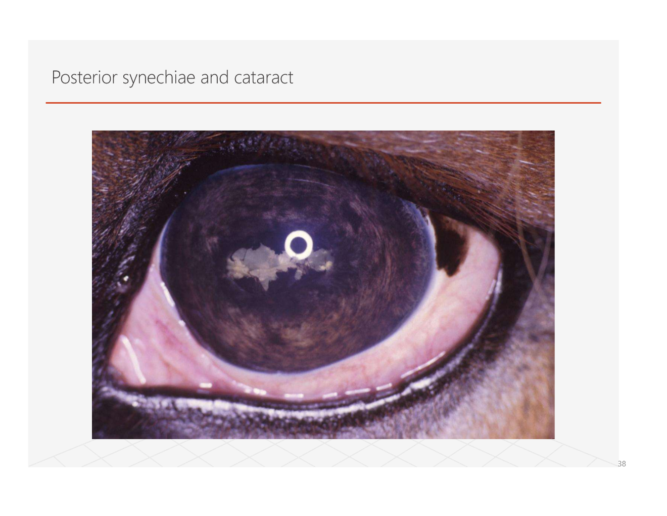 <p>developed from uveitis</p>