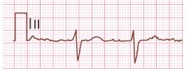 <p>What is the EKG gain of the tracing below?</p>