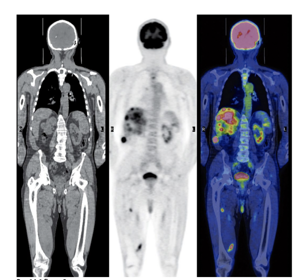 FdG in Cancer Diagnosis