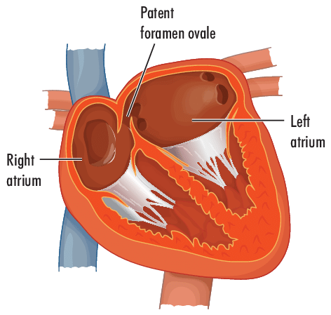 <p>patent foramen ovale </p><ul><li><p>in the wall between the left and right atria of a fetus </p></li></ul><p></p>