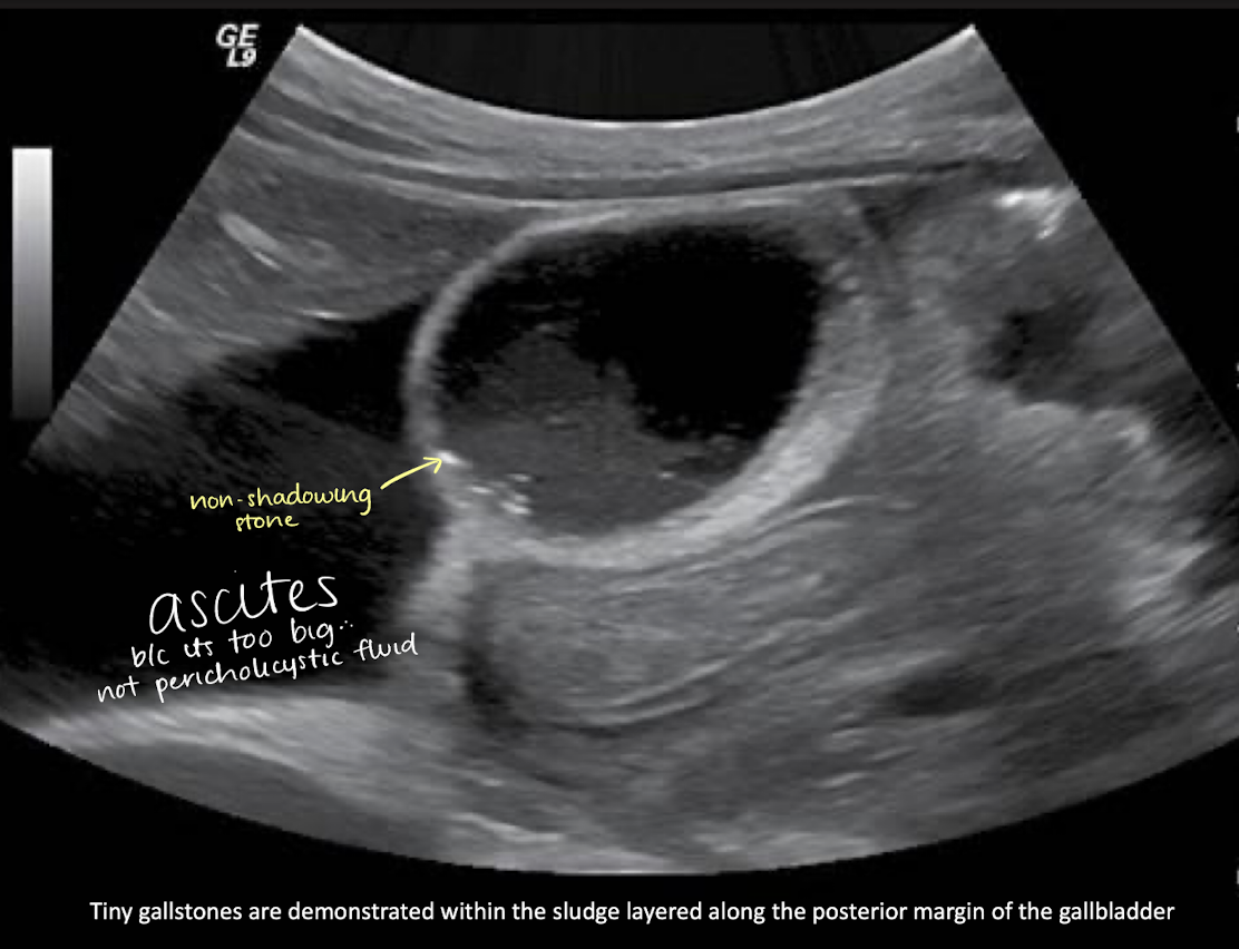 <p><mark data-color="yellow" style="background-color: yellow; color: inherit;">cholelithiasis</mark></p><ul><li><p>tiny stones along sludge layer + ascites</p></li></ul><p></p>