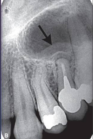 <p>What is odontogenic mucositis?</p>