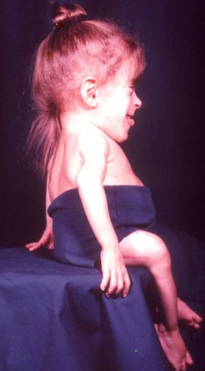 <p>What are some craniofacial features of osteogenesis imperfecta?</p>