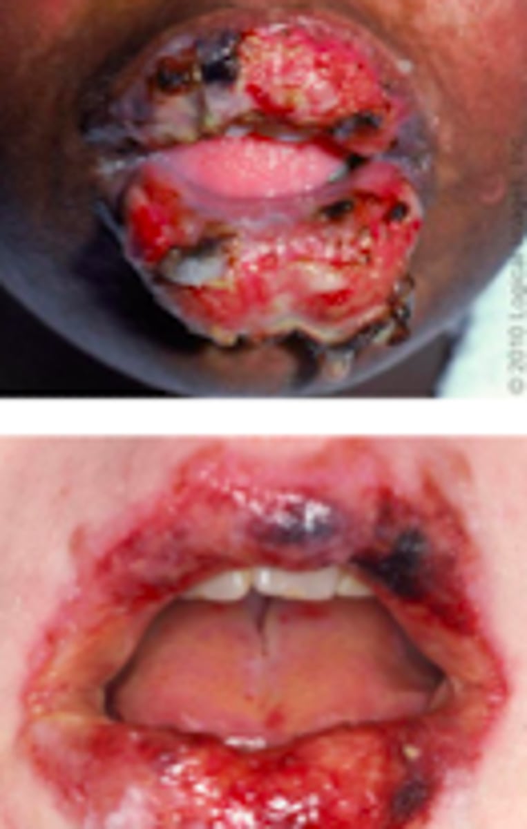 <p>Desquamation Disorders:</p><p>Objective:</p><p>General:</p><p>- Fever &gt;100.4</p><p>- Mucositis</p><p>- Skin tenderness, Skin lesions and blistering</p><p>Pt will show: </p><p>- cutaneous lesions (ill-defined, erythematous macules with purpuric centers, start on face and thorax before spreading, symmetrically distributed, scalp, palms, and sores typically spared, skin will eventually slough)</p><p>- + Nikolsky sign</p><p>- + Asboe Hansen Sign (bulla spread sign)</p><p>- mucosal and oral lesions (painful, hemorrhagic erosions covered with grayish-white membrane)</p><p>- ocular (severe conjunctivitis with purulent discharge, corneal ulceration, pain &amp; photophobia)</p><p>- urogenital lesions (may lead to urinary retention)</p><p>- pharyngeal mucosa (trachea, bronchial, esophagus membranes)</p>