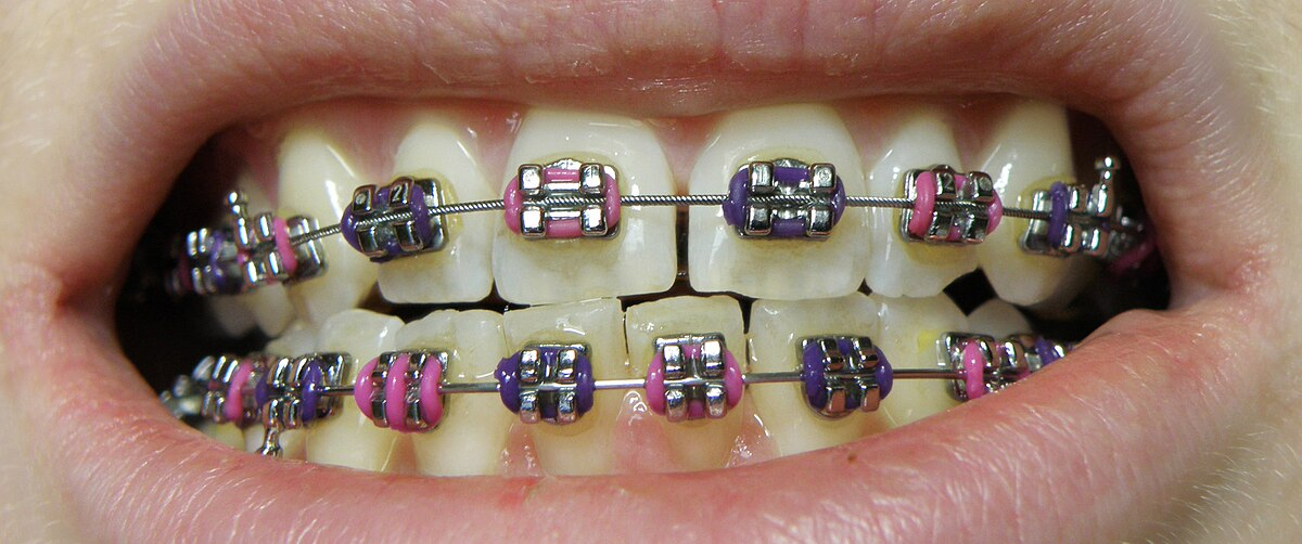 <p>Special-use materials like brackets, bands, elastics, sutures, desensitizing agents, paper, waxes, and gutta-percha.</p>