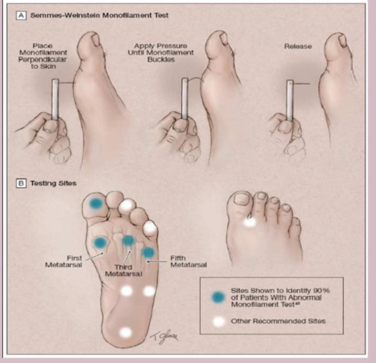 <p>Dx</p><p>-comprehensive foot exam </p><p>-screening yearly foot exam </p><p>-skin inspection, pulses, ankle reflexes, proprioception of great toe, vibratory sensation, monofilament exam </p>