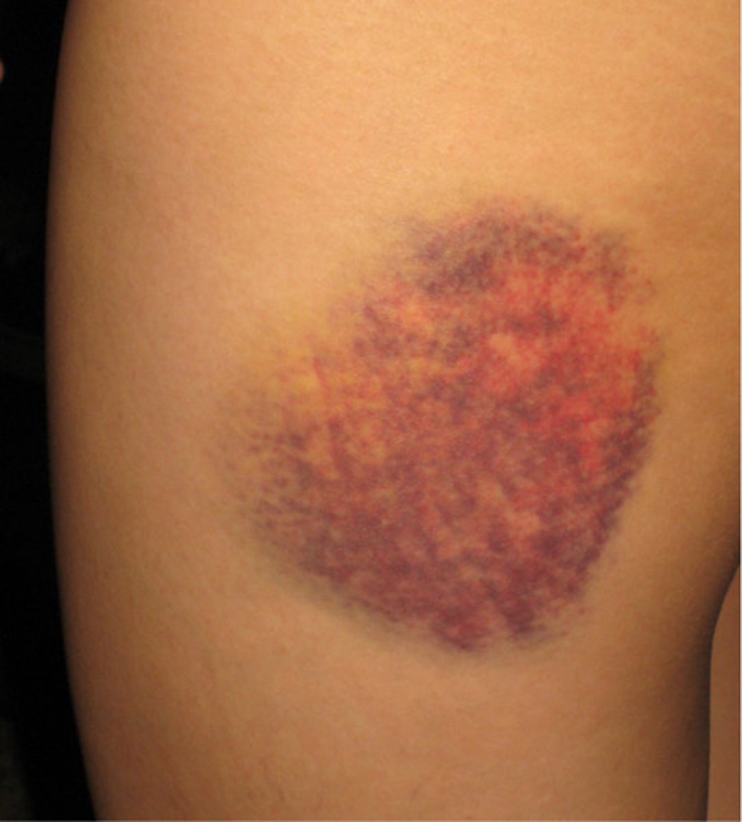 <p>wound that does not break the surface of the skin</p>