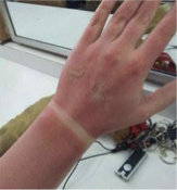 Only epidermis layer
Redness, pain and swelling
No scaring
Healing time: 1-2 weeks
Caused. By: sunburn or brief exposure to hot and cold surfaces