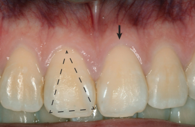 <p>Slender, triangular-shaped crown</p><p>Thick, fibrotic gingiva</p><p>Narrow-to-moderate zone of keratinized tissue</p><p>Accentuated scalloped gingival margin contour</p><p>Prone to development of mucogingival deformity</p>