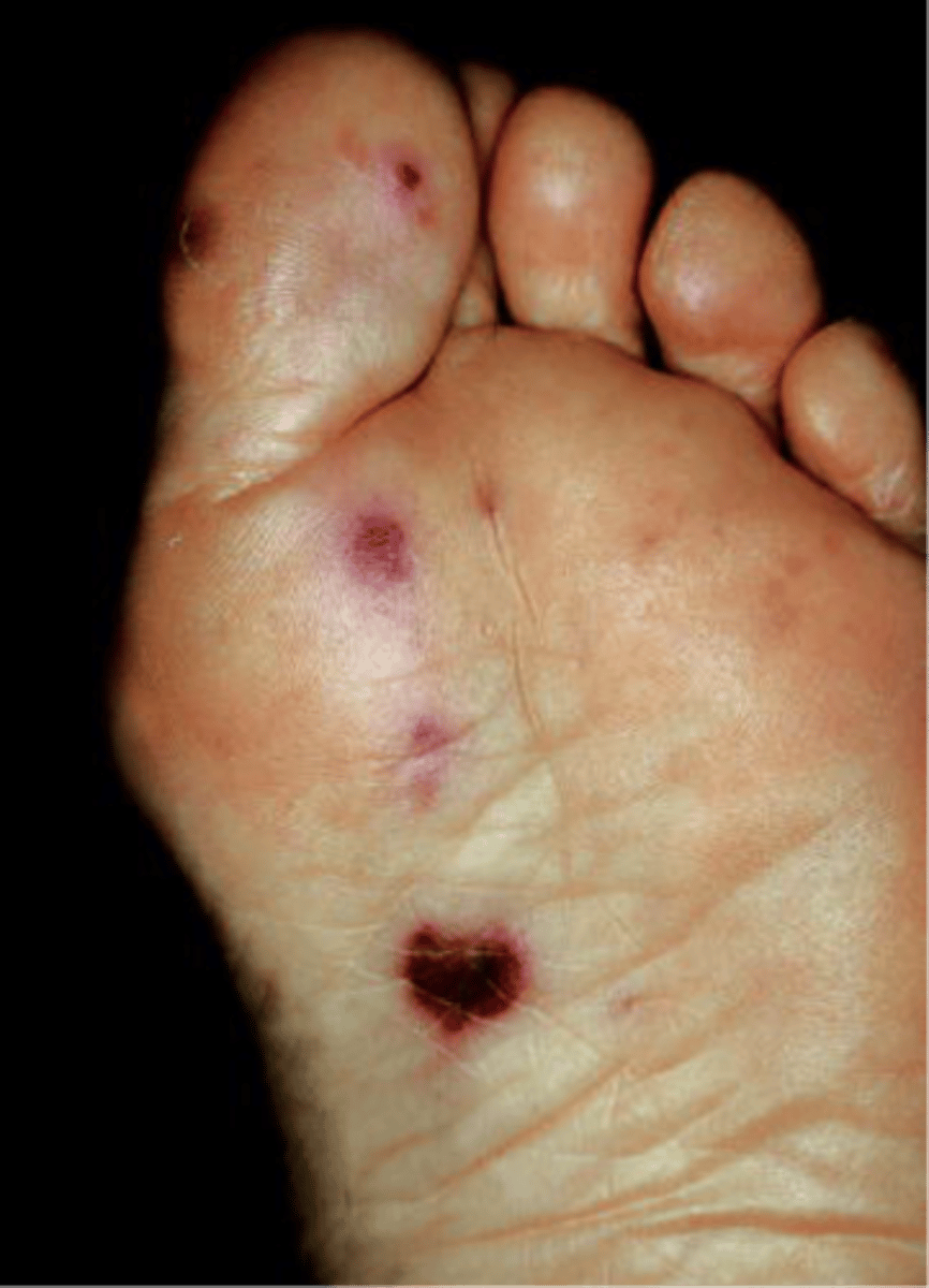 <p>flat, painless, small, red spots that may be found on the palms and soles in patients with infective endocarditis</p>