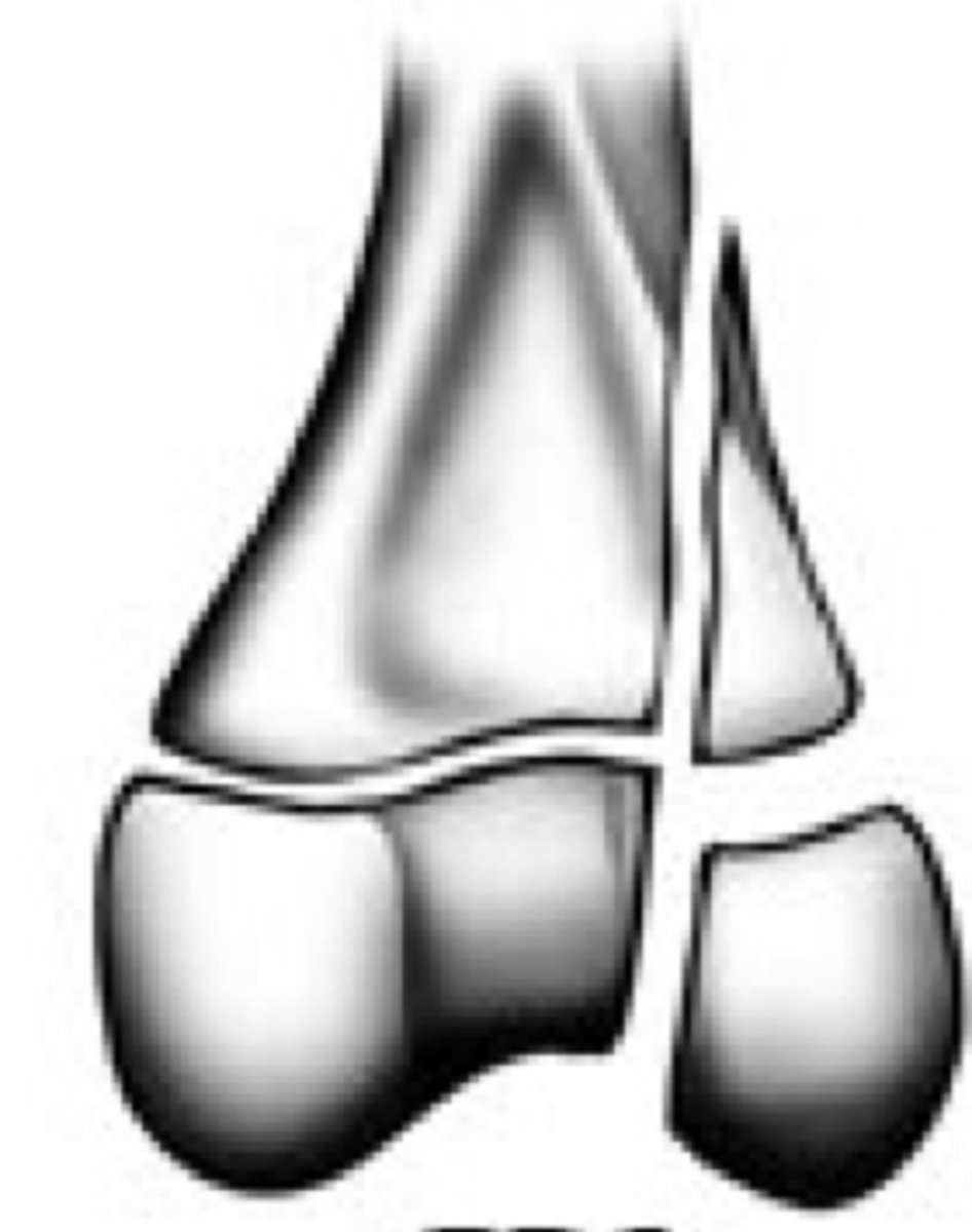 <p>Grade the Salter-Harris fracture?</p>