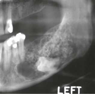 <p>describe the density of the lesion adjacent to the molar </p>