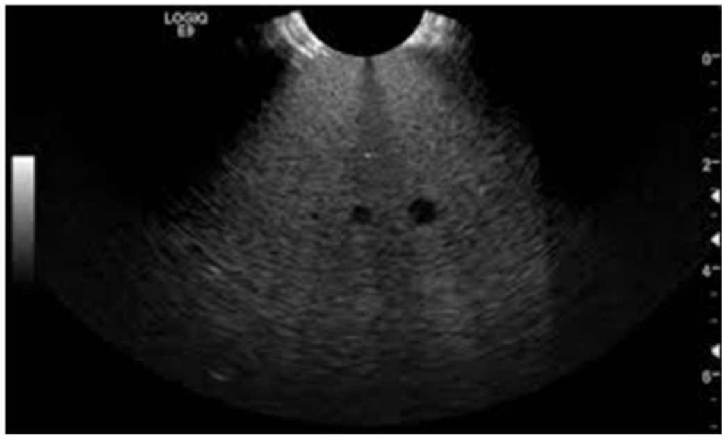 <p>Using a TE phantom, image a homogeneous region and look for any areas of non-uniformity.</p>