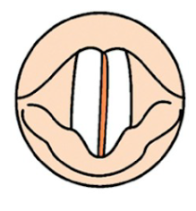 What type of VF closure is this?