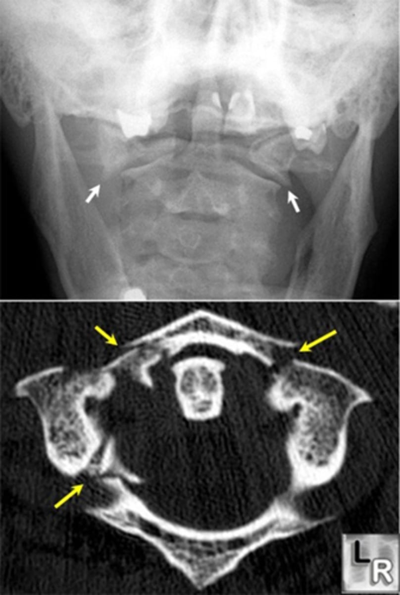 <p>- Fracture of C1 (atlas)</p><p>- Head first fall from height (e.g., diving into pool, hit head)</p><p>- Pain, but typically no neural signs</p>