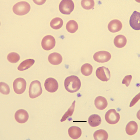 <p>What is the inclusion in this erythrocyte?</p>