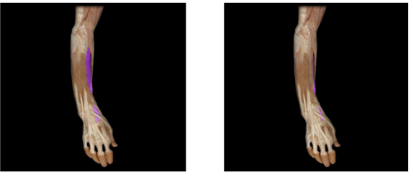 <p>Action: Wrist extension and radial deviation</p>