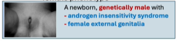 <p><span style="background-color: transparent;"><strong><span>Complete Androgen Inensitivity Syndrome (CAIS)</span></strong></span></p><p><span style="background-color: transparent;"><span>Lack of testosterone action</span></span></p><p><span style="background-color: transparent;"><span>Female phenotype</span></span></p><ul><li><p><span style="background-color: transparent;"><span>May appear to have fully developed breast, female-like distribution off fat &amp; hair</span></span></p></li></ul><p></p>