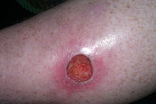 <p>what type of lesion is depicted</p>