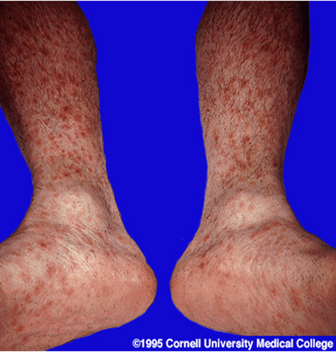 <p>- occurs 1-3 mo and is when syphilis is systemic and not local anymore (skin and mucous lesions) </p><p>- can now test + for antibodies</p><p>- alopecia, flu- like symp., ocular syphilis (MOST common stage for ocular syphilis) </p>