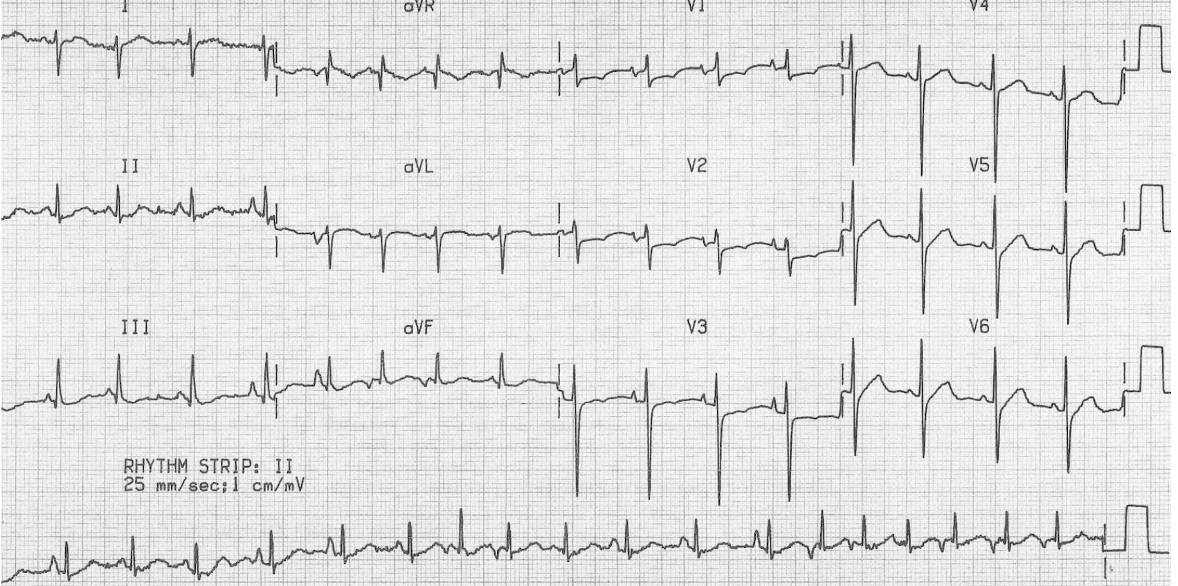 <p>For our younger patients with a fib what is the game plan</p>