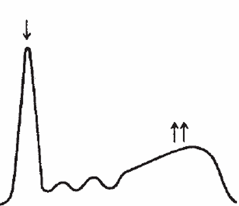 <p>Polyclonal Gammopathy</p>